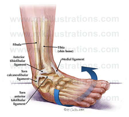 ankle sprain sprained